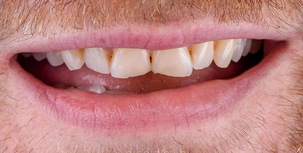 Restoring worn and chipped teeth before treatment at ProDent