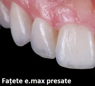 Fațete dentare E.max Cluj – fațete ceramice premium pentru zâmbet natural la ProDent