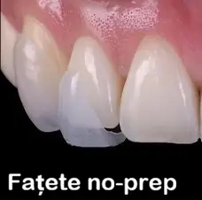 Fațete dentare no-prep Cluj – fațete fără șlefuire pentru corectarea esteticii dentare