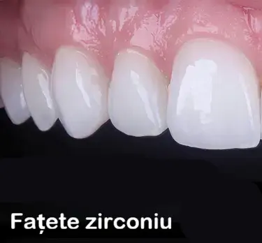 Fațete dentare din zirconiu Cluj – fațete rezistente pentru restaurări estetice durabile