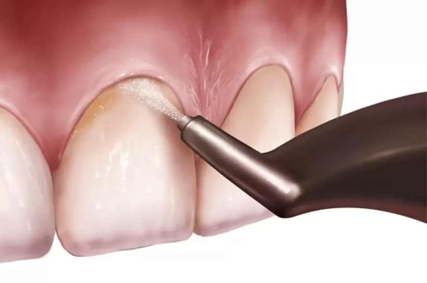 Airflow dentar Cluj