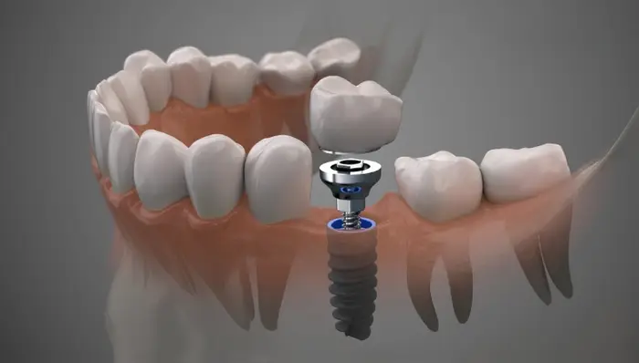 Implant dentar Cluj la ProDent – tratament planificat digital
