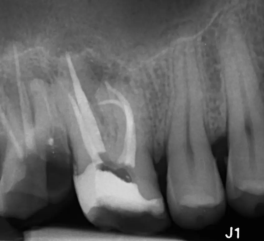 Radiografie after – retratament endodontic, caz #2
