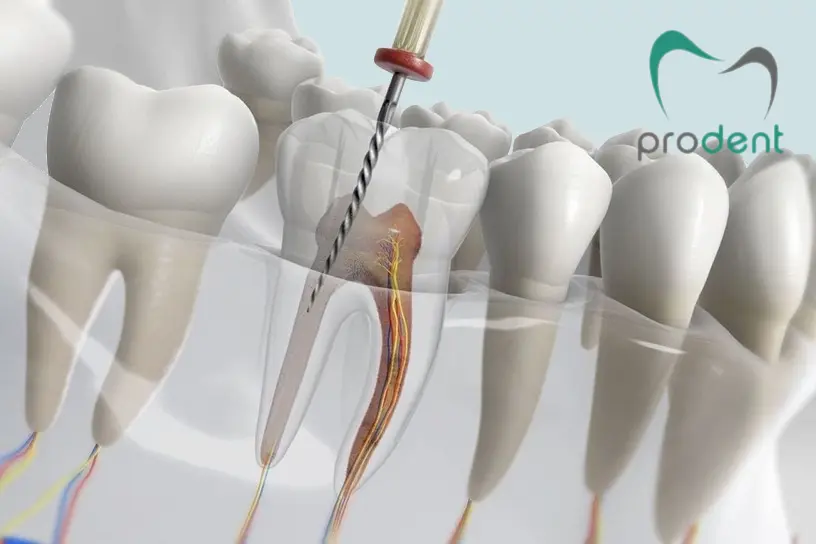 Tratament de canal Cluj – endodonție la microscop ProDent