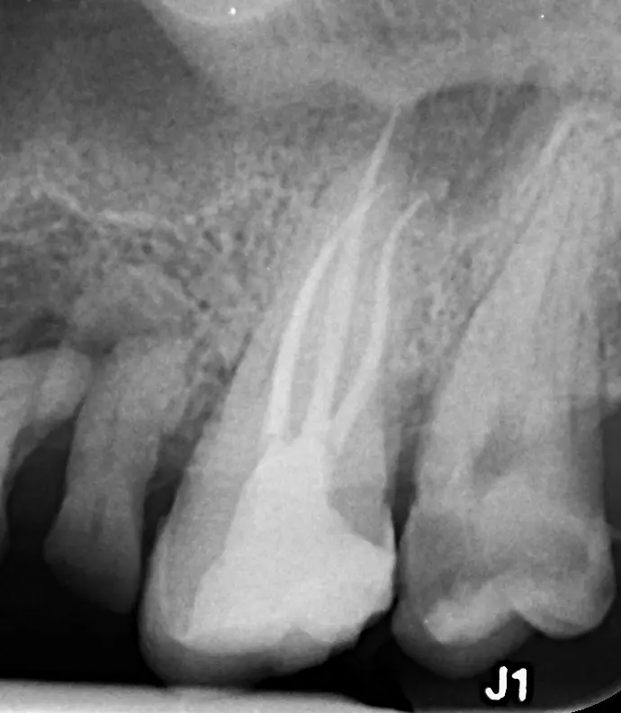 Radiografie after – tratament de canal la microscop, caz #3