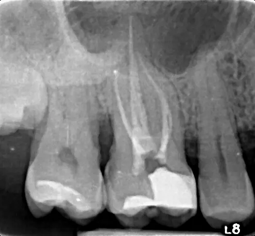 Radiografie after – tratament de canal molar, caz #1