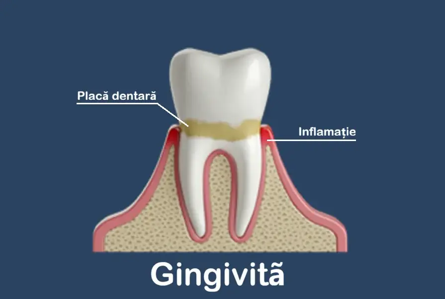 Gingivită – sângerări gingivale