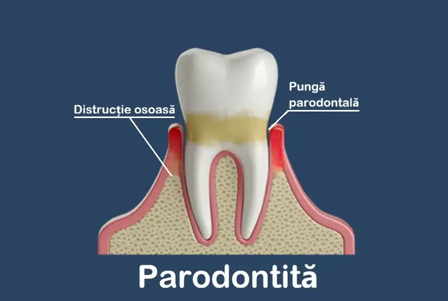 Parodontită – pungi parodontale