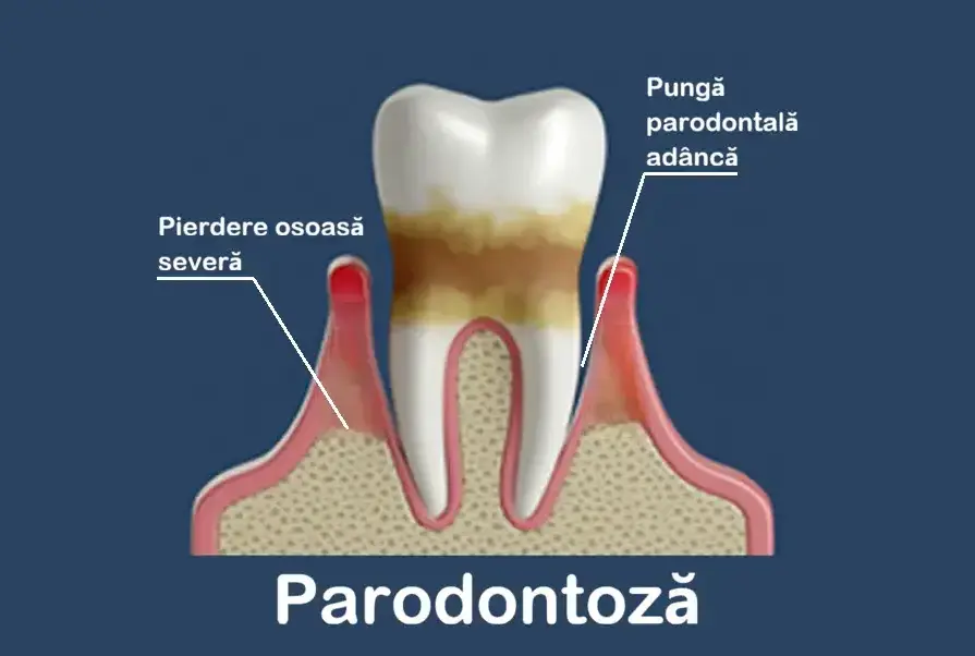 Parodontită avansată – mobilitate dentară